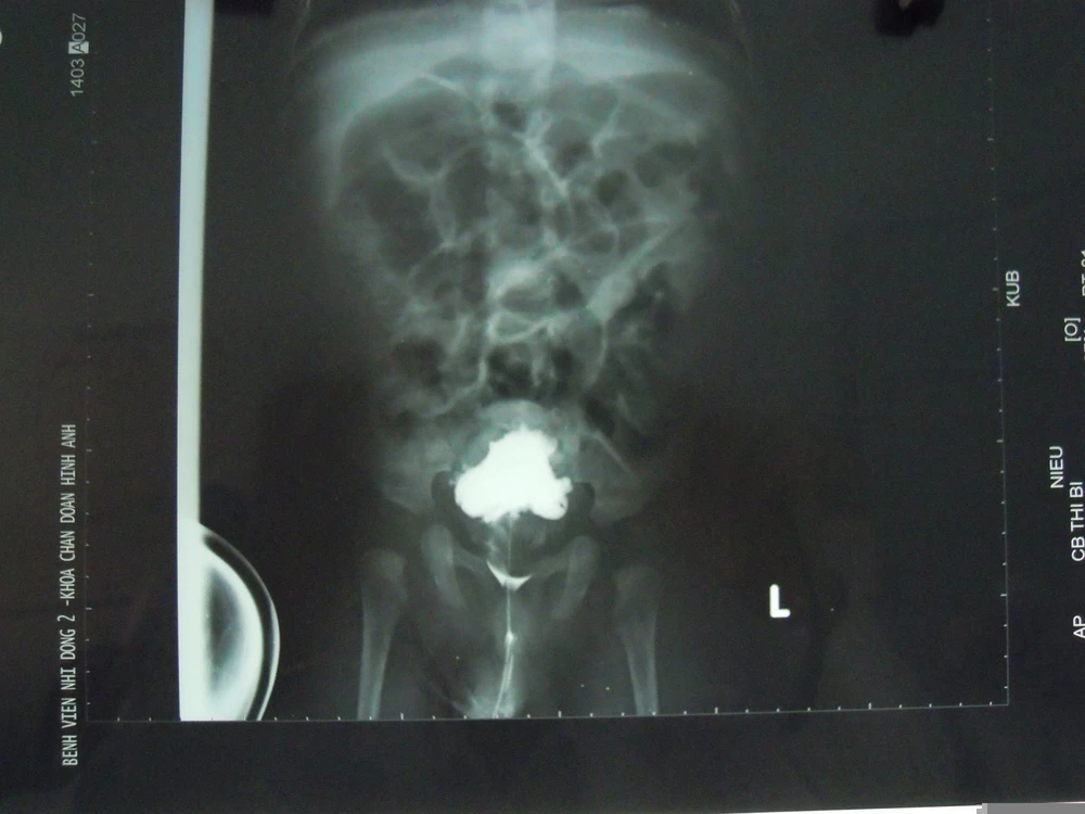 Trẻ bị vỡ bàng quang do dị tật niệu ảnh 2